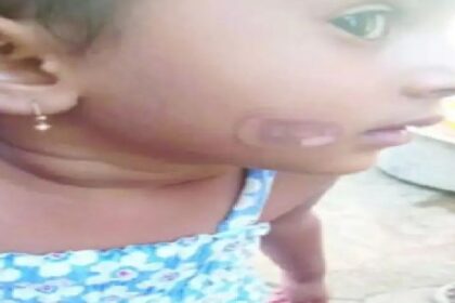 ಬಾಲಕಿಯ ಕೆನ್ನೆಗೆ ಬಿಸಿ ಚಮಚದಿಂದ ಬರೆಯಿಟ್ಟ ಅಂಗನವಾಡಿ ಸಹಾಯಕಿ