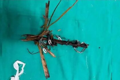 12 ವರ್ಷದ ಬಾಲಕನ ಎದೆಗೂಡಿಗೆ ಸೇರಿದ ತೆಂಗಿನ ಗರಿ ಹೊರತೆಗೆದ ವೈದ್ಯರು 