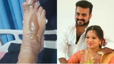 ಕಾಲಿನ ಮೇಲೆ ಬಿಸಿ ನೀರು ಬಿದ್ದು ಮಾಸ್ಟರ್ ಆನಂದ ಪತ್ನಿಗೆ ಗಾಯ