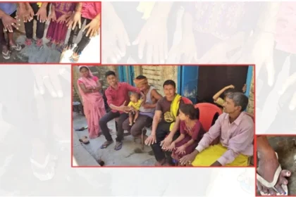 ಈ ಕುಟುಂಬದಲ್ಲಿ 50 ಜನರಲ್ಲಿ ಪ್ರತಿಯೊಬ್ಬರಿಗೂ 24 ಬೆರಳುಗಳಿವೆ! ಮದುವೆಯಾಗುತ್ತಿಲ್ಲ.ಕೆಲಸ ಸಿಗ್ತಲ್ಲ