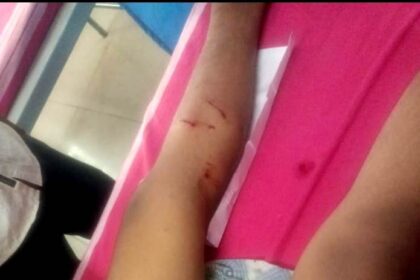 ಶಾಲಾ ಮಕ್ಕಳು, ವೃದ್ದರ ಮೇಲೆ ಬೀದಿ ನಾಯಿಗಳ ದಾಳಿ, ತೀವ್ರ ಗಾಯ