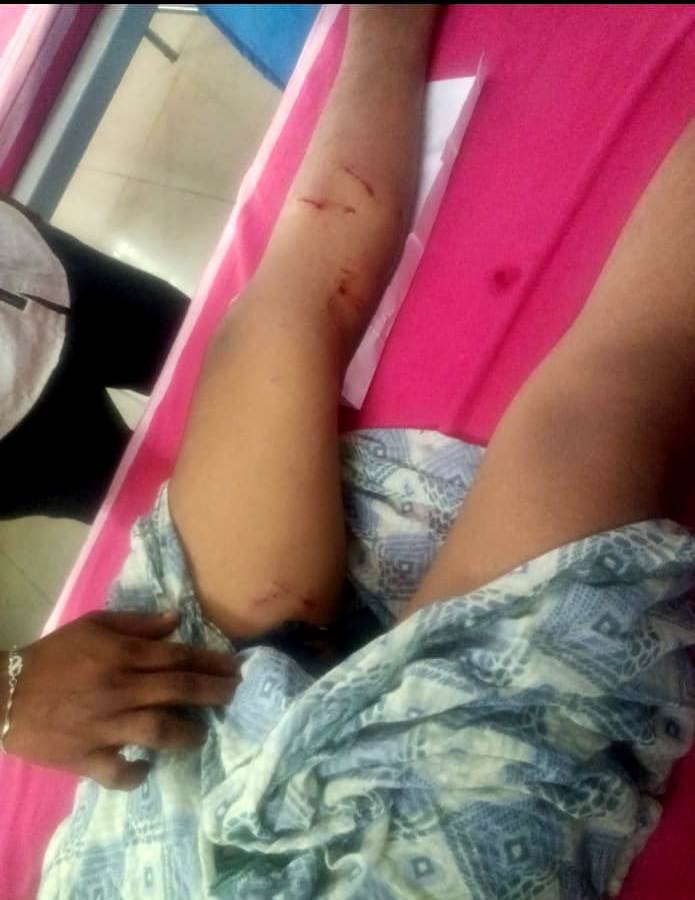 ಶಾಲಾ ಮಕ್ಕಳು, ವೃದ್ದರ ಮೇಲೆ ಬೀದಿ ನಾಯಿಗಳ ದಾಳಿ, ತೀವ್ರ ಗಾಯ