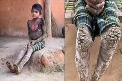 ಬಾಲಕಿಗೆ ವಿಚಿತ್ರ ಚರ್ಮ ರೋಗ : ಮರದ ತೋಗಟೆಯಂತಾದ ದೇಹ