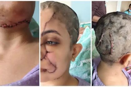 ಸಾಕು ನಾಯಿ ಡೆಡ್ಲಿ ಅಟ್ಯಾಕ್ : ಮಹಿಳೆಗೆ ಬಿತ್ತು 50ಕ್ಕೂ ಹೆಚ್ಚು ಹೂಲಿಗೆ, ಎಫ್‌ಐಆರ್ ದಾಖಲು