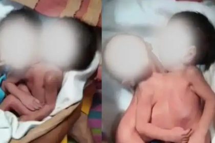 ಸಂಯೋಜಿತ ಅವಳಿ ಮಕ್ಕಳಿಗೆ ಜನ್ಮ : ಆಘಾತದಿಂದ ತಾಯಿ ಸಾವು 