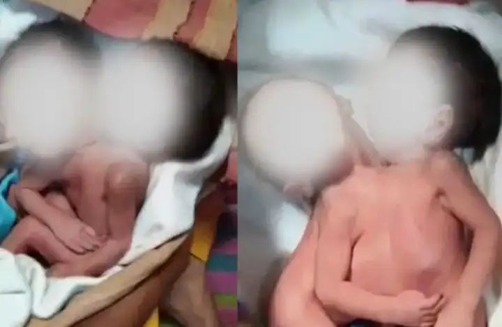 ಸಂಯೋಜಿತ ಅವಳಿ ಮಕ್ಕಳಿಗೆ ಜನ್ಮ : ಆಘಾತದಿಂದ ತಾಯಿ ಸಾವು 